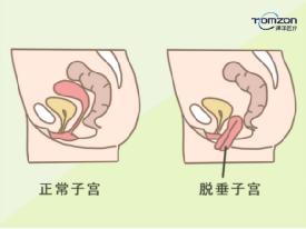 盆底肌修復(fù)儀器用對地方治療很有效