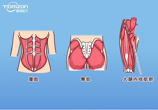 凱格爾運(yùn)動該怎么做？盆底肌修復(fù)儀器效果會更好嗎？