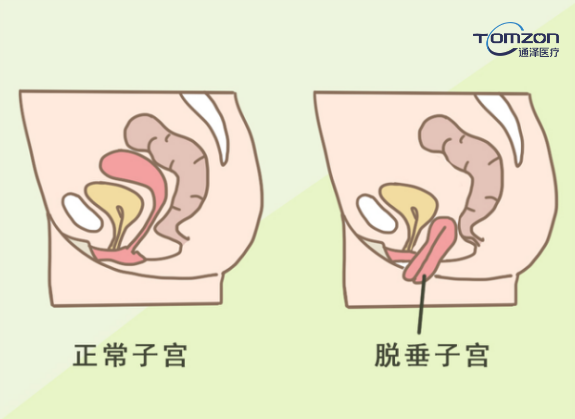 盆底康復(fù)治療儀能夠改善什么樣的情況？