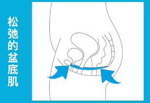 盆底肌修復